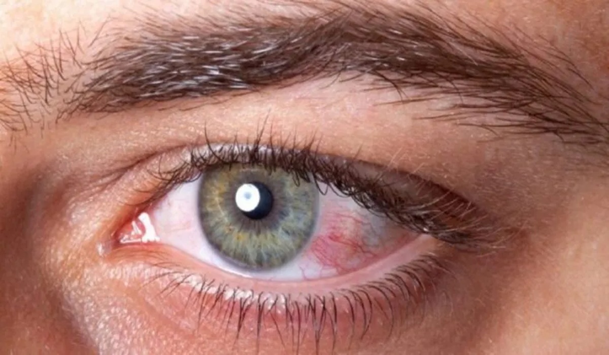 Conheça os sintomas que indicam que você está tendo um derrame ocular e