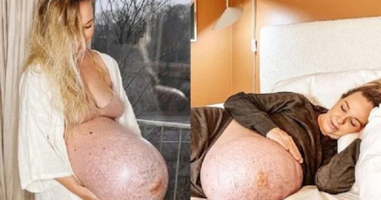 Grávida de trigêmeos deixa internautas impressionados ao mostrar estado da barriga