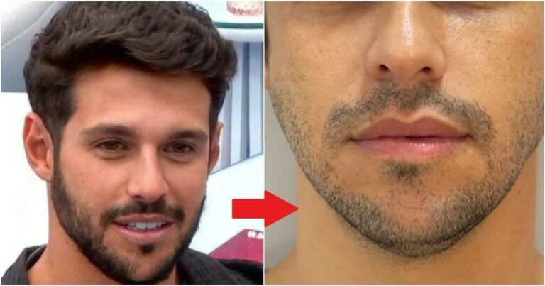 BBB22: Vaza fotos do antes e depois da harmonização de Rodrigo e choca web; ‘meu Deus o que o dinheiro não faz’