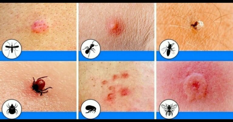 8 picadas de insetos que todos deveriam saber identificar para ter o tratamento correto