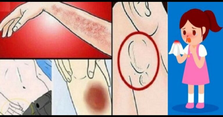 Não ignore esses 15 sintomas que mostram que você está com leucemia