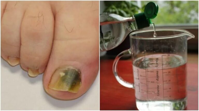 Livre-se dos fungos das unhas usando apenas receitas caseiras