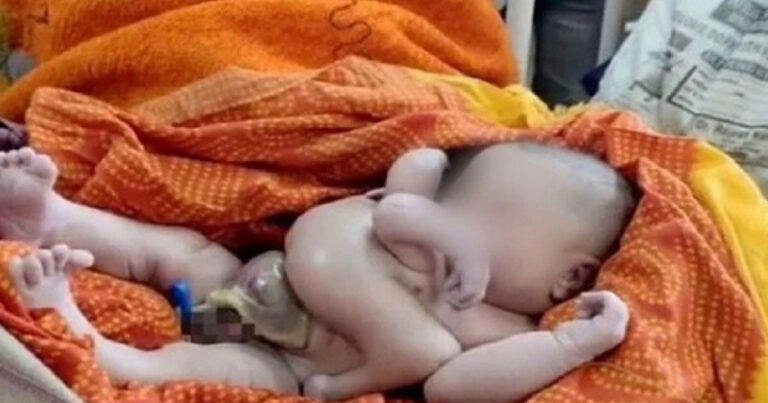 Bebê nasce com quatro pernas e quatro braços e fiéis adoram acreditando que ele é um deus