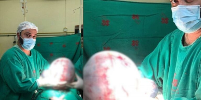 Médicos removem cisto de 10 kg do ovário de paciente, fotos assustam as redes sociais