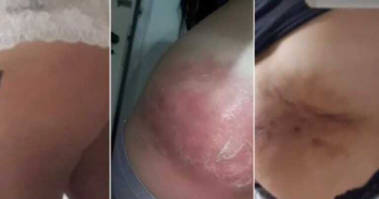 Mulher tem corpo deformado por causa de injeção e gera alerta para profissionais e pacientes