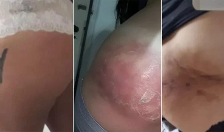 Mulher tem infecção grave e fica com bumbum deformado após injeção