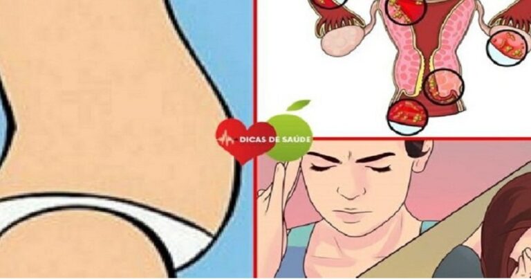 Câncer no ovário: esses são os 9 sintomas que podem revelar que você está com a doença