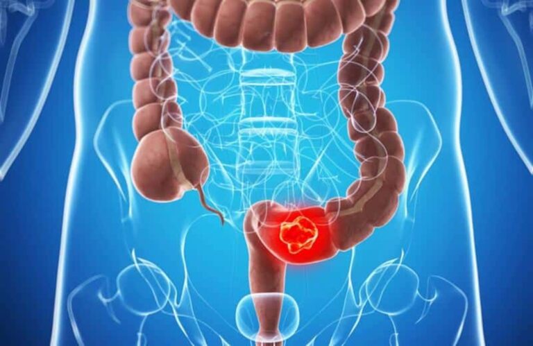 Câncer no intestino: entenda as causas e sintomas da doença