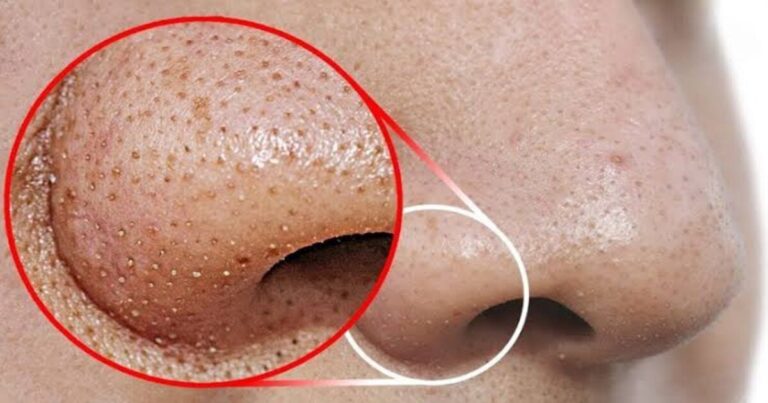 Como remover espinhas em casa? 3 dicas para dar adeus as espinhas