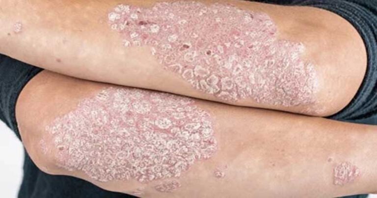 Os 7 sinais que podem indicar psoríase; doença não tem cura e afeta milhões de brasileiros