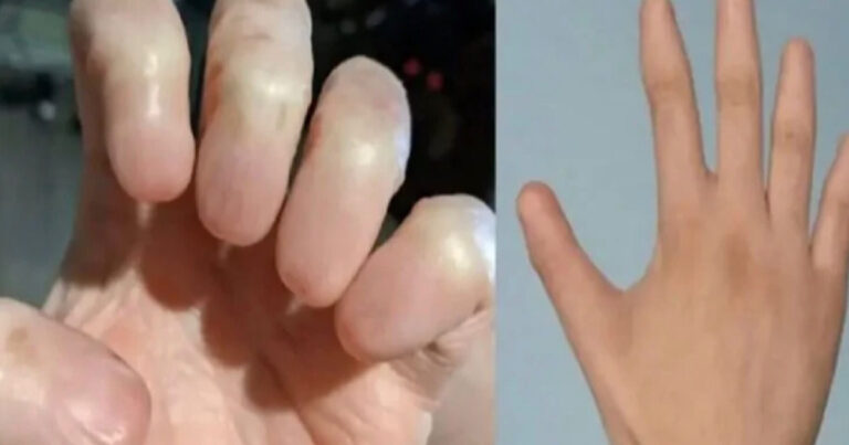 Foto de mão sem unha se torna viral nas redes sociais; saiba mais sobre a condição