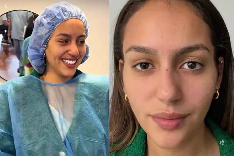 Brasileira viraliza ao fazer cirurgia para mudar cor dos olhos