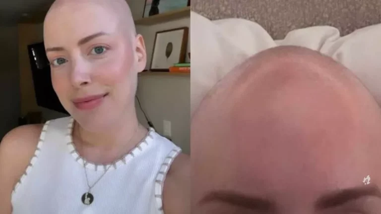Lutando contra câncer, Fabiana Justus entrega detalhes sobre a sensação de estar sem cabelo: “Doido”