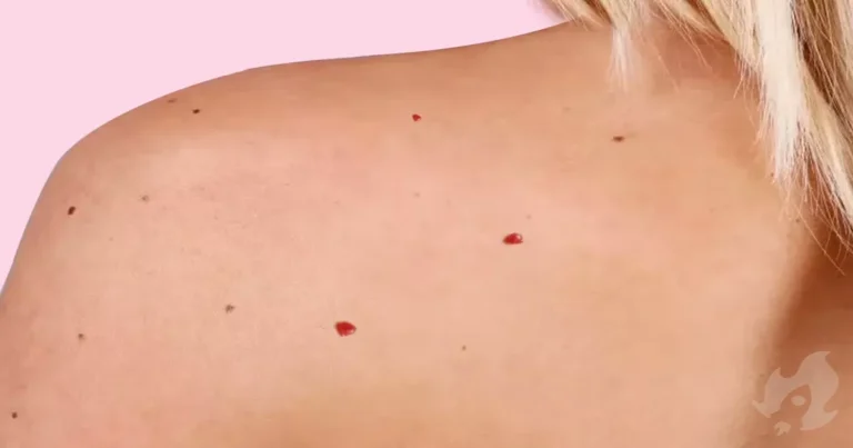 Pintinhas vermelhas(de sangue) na pele. Devemos nos preocupar…