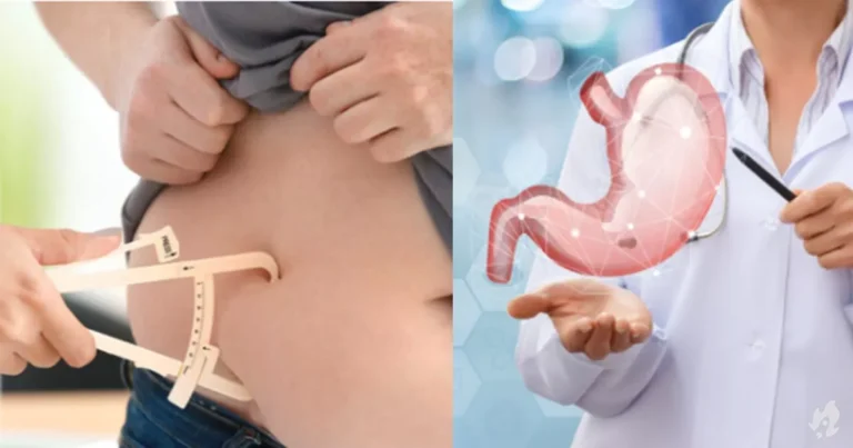 Saiba como é feita a cirurgia bariátrica, seus riscos e benefícios