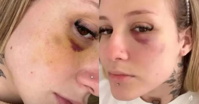 Ex-mulher de jogador, Clara Monteiro exibe hematomas de agressão