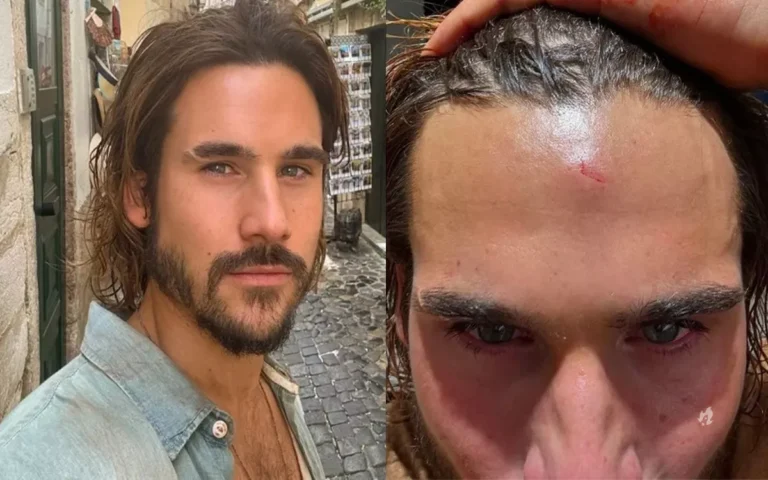 Nicolas Prattes se machuca durante gravação de “Mania de Você”: “Coronhada de verdade”