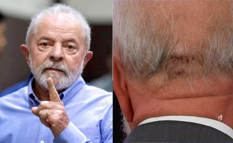 Médico alerta sobre possíveis complicações para Lula após acidente doméstico: ‘Sangramento pode aumentar’
