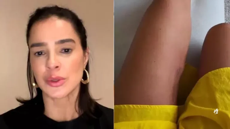 Esposa de Rodrigo Faro, Vera Viel entrega sequela após câncer: “assim vai ser”
