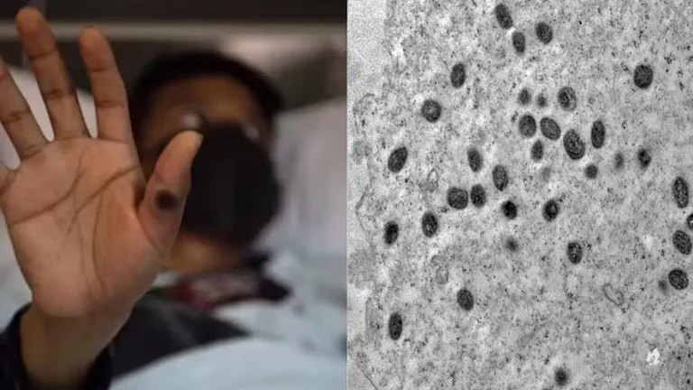 SP identifica primeiro caso brasileiro de nova cepa do vírus Mpox, responsável por surto na África