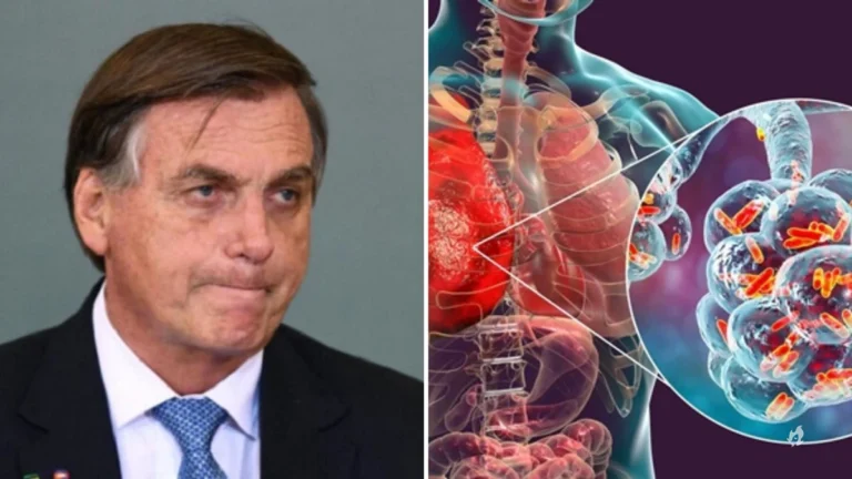 Pneumonia viral: entenda novo diagnóstico de Bolsonaro