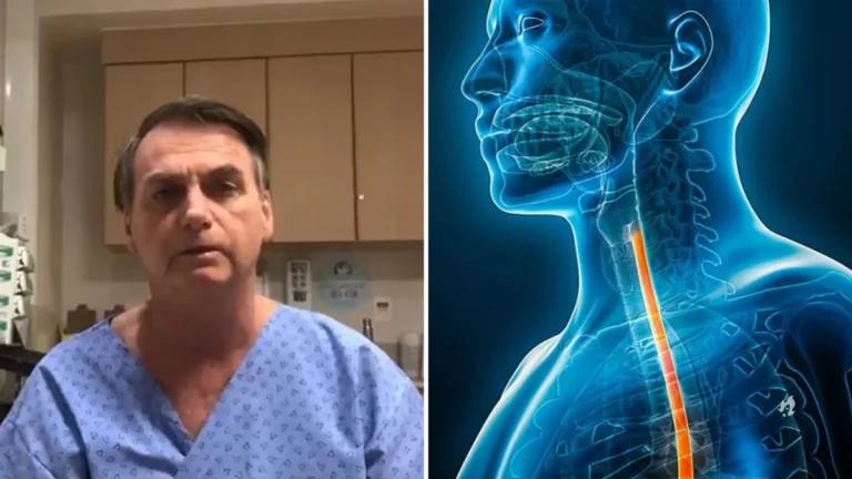 Esofagite: causas, sintomas e tratamento da condição que acarretou na internação de Bolsonaro