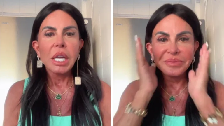 Gretchen mostra resultado de nova harmonização: “Não existe desarmonização”