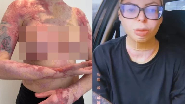 Mulher que teve 32% do corpo queimado após panela de fondue explodir em SC relata luta diária: Derretia como cera