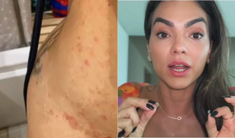 Doença sem cura e inflamatória que afeta Kelly Key pode piorar com estresse e mudança de estação; médica explica