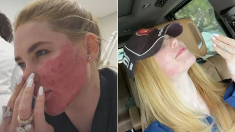 Virginia questiona decisão de fazer procedimento que deixou rosto ‘em carne viva’: “Tinha necessidade?”