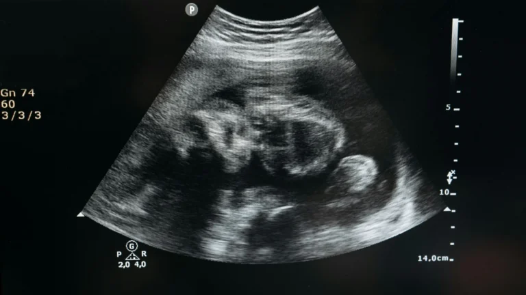 Justiça do RS cancela júri popular de mulher acusada de abortar em banheira