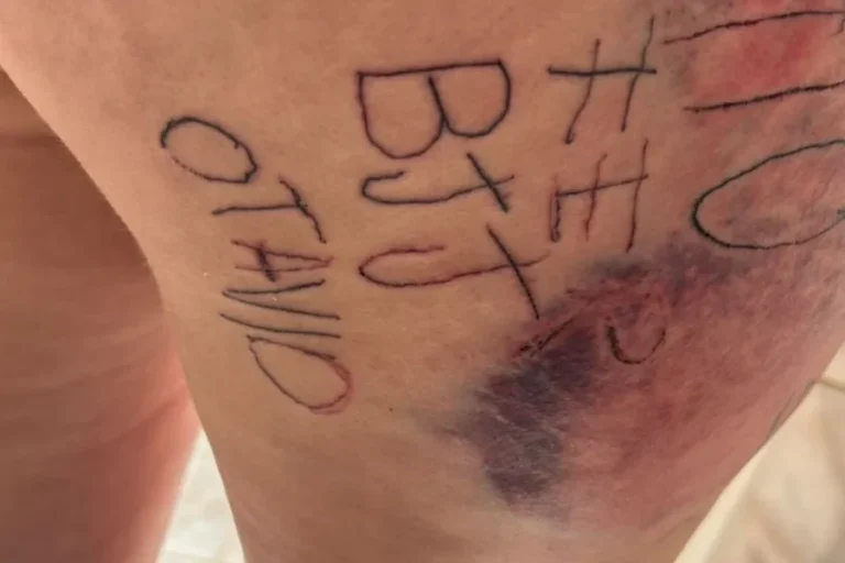 Mulher é torturada e tatuada à força por companheiro. Imagens fortes