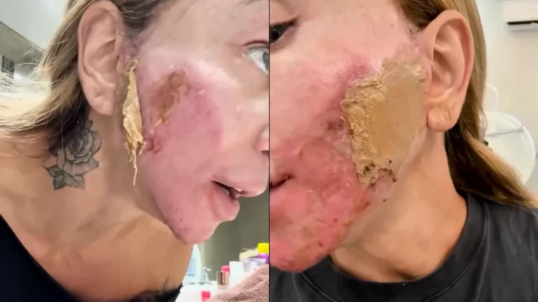 Entenda o procedimento que deixou Maya Massafera com rosto “queimado”