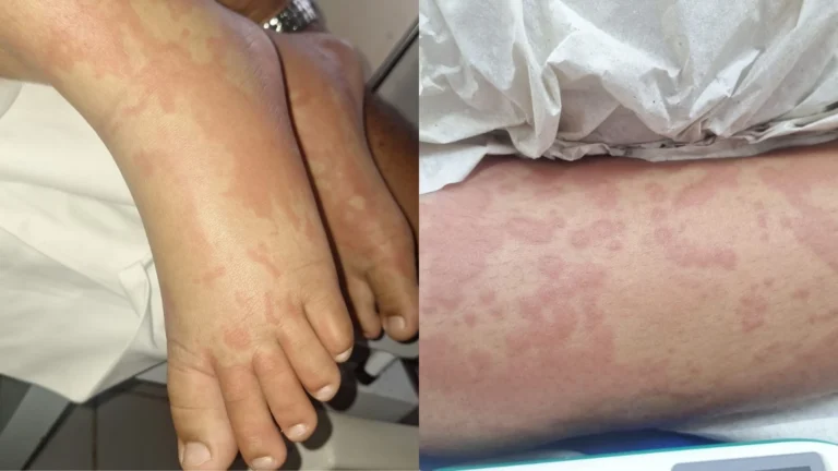 Criança internada após entrar em contato com detergente tem alta médica