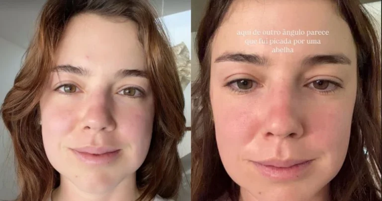 Alice Wegmann revela procedimento recente e mostra inchaço do rosto