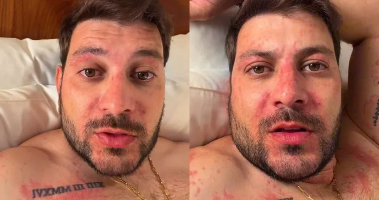 Ex-BBB Caio Afiune tem crise alérgica “assustadora” e vai a hospital
