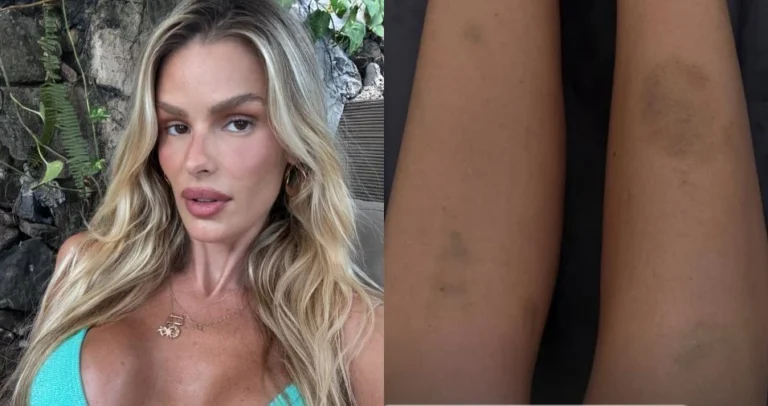 Yasmin Brunet desabafa sobre lipedema ao mostrar hematomas na perna