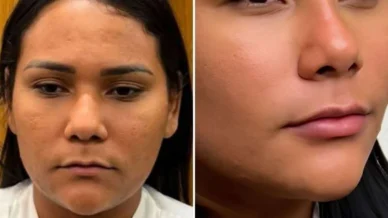 Ex-BBB Chaiany mostra resultado de harmonização facial e web avalia: Outra pessoa