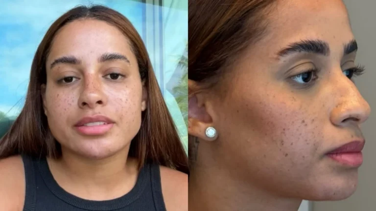 Lomma detalha todos os procedimentos estéticos que fez no rosto: “Boneca”