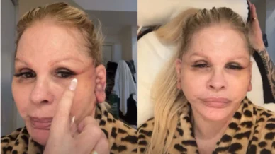 Monique Evans faz procedimento no rosto e revela que ficou 