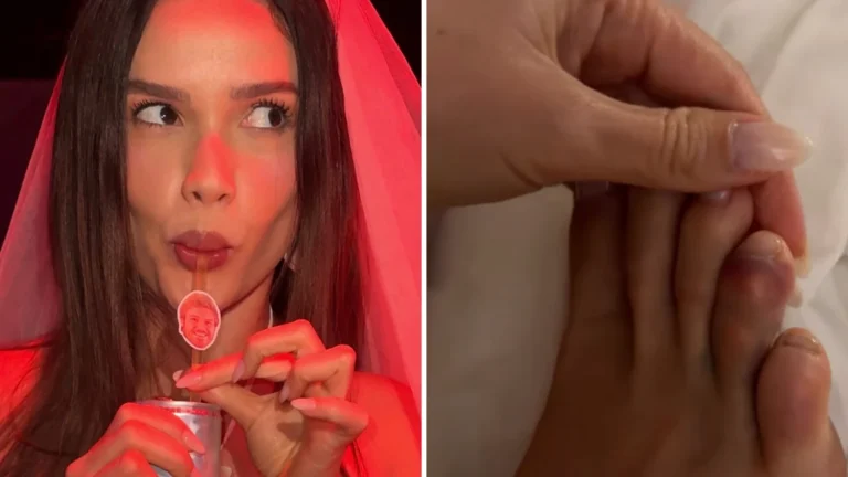 Juliette mostra hematomas após despedida de solteira: “Fim do mundo”